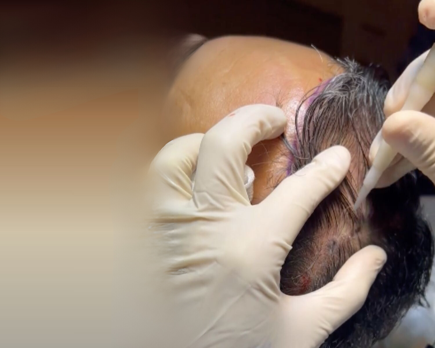 DOUBLE DHI HAIR TRANSPLANT (NO SHAVE)